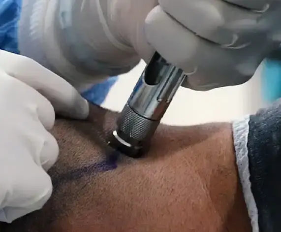 Needle Method Hair Transplant