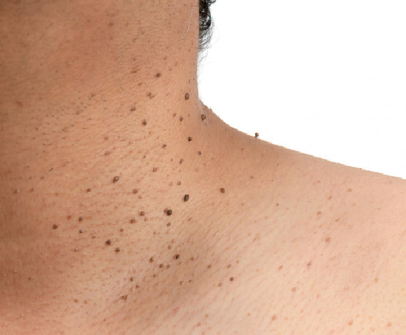 What are Warts?
