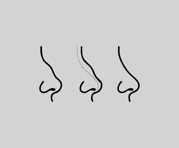 The Rhinoplasty Procedure